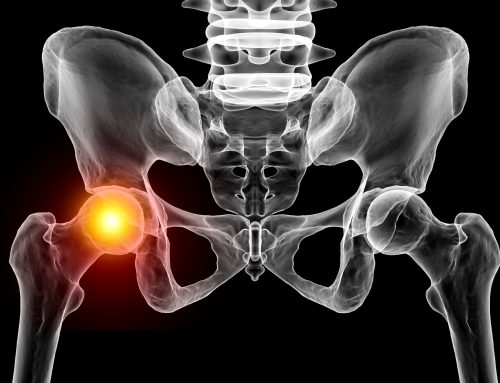 Hip Replacement Surgery: What to Expect Before, During, and After