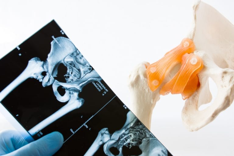 Hip Resurfacing vs