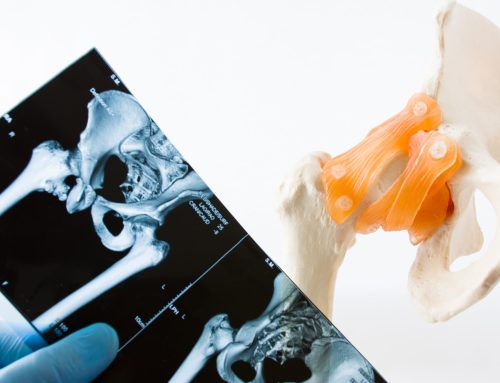 Hip Resurfacing vs. Hip Replacement: Which Is Right for You?