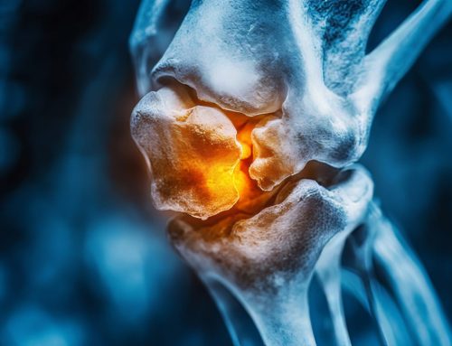 Is It the Start of Knee Osteoarthritis? What to Watch For